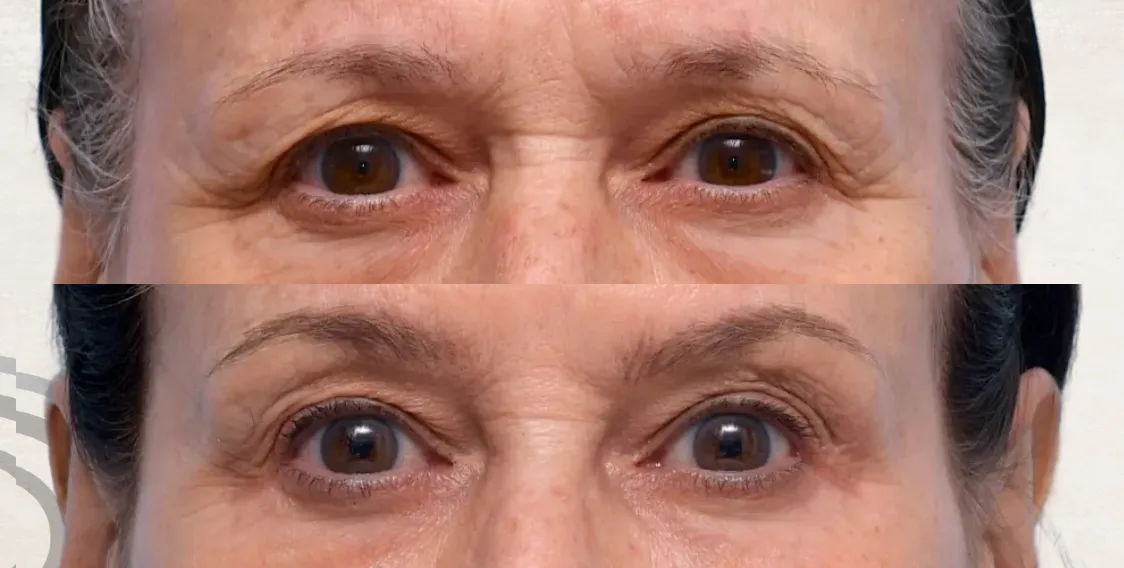 Eyebrow Lift